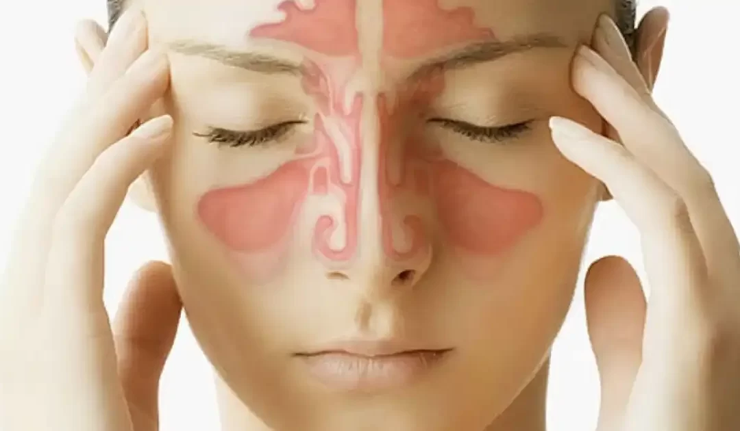 La rinite vasomotoria allergica